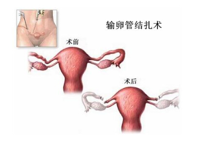 郑州天伦不育不医院  患者疑问：结扎后还能怀孕吗？